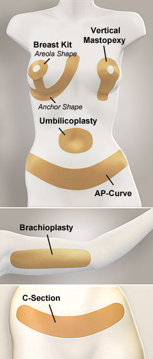 Oleeva Scar Shapes from Bio Med Sciences are specially designed to treat scarring from breast, abdominal and other surgical procedures.